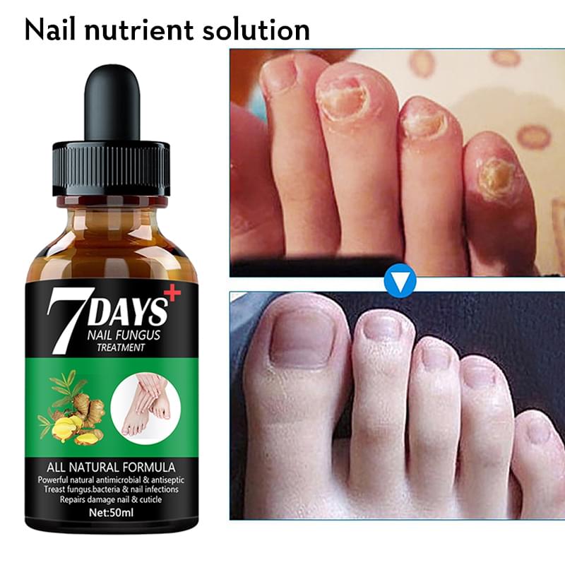 7DAYS Nail Fungus Treatment Serum Care Hand And Foot Care Removal.