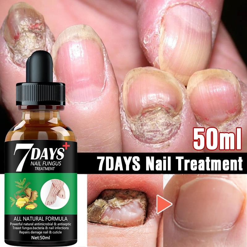 7DAYS Nail Fungus Treatment Serum Care Hand And Foot Care Removal.