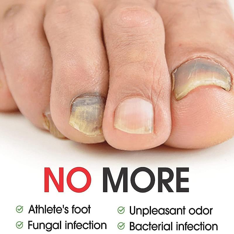 7DAYS Nail Fungus Treatment Serum Care Hand And Foot Care Removal.
