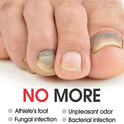 7DAYS Nail Fungus Treatment Serum Care Hand And Foot Care Removal.