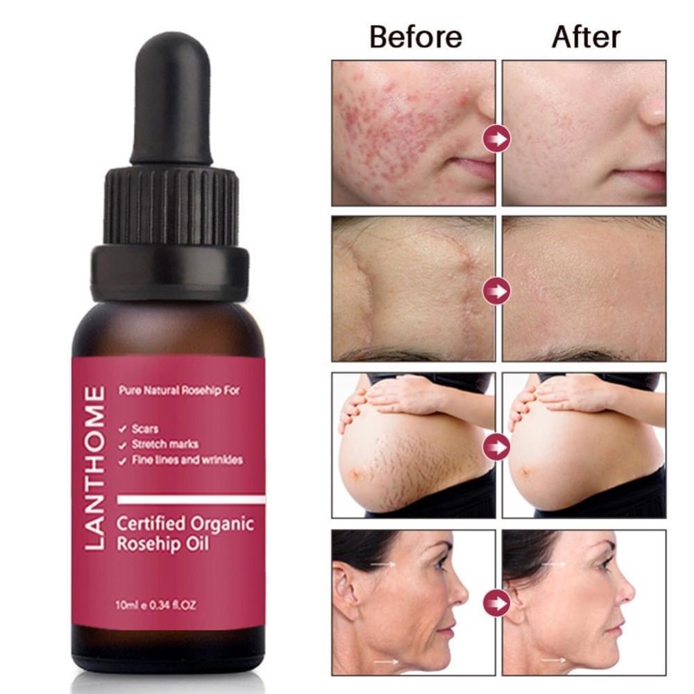 Moisturizing and moisturizing rosehip oil.
