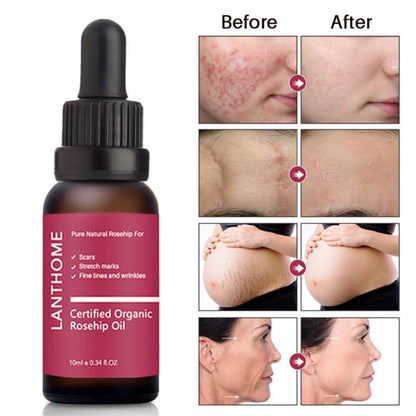 Moisturizing and moisturizing rosehip oil.